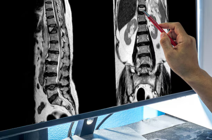 Minimal Invasive Spine Surgeries